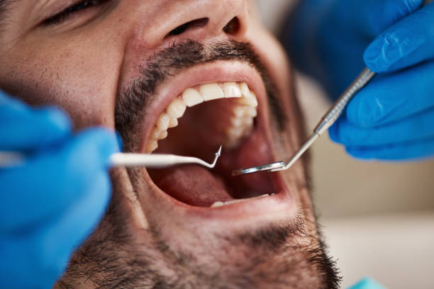 Best Emergency Tooth Extraction in White Settlement, TX