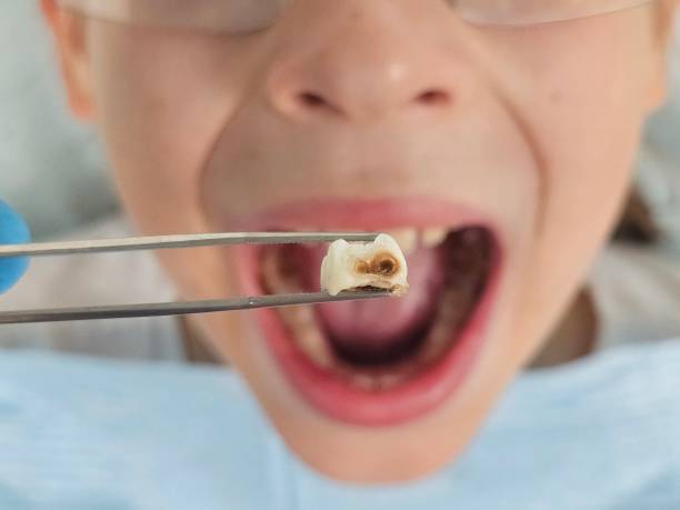 Best Emergency Wisdom Teeth Removal in White Settlement, TX